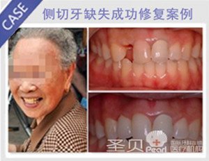 侧切牙缺失成功修复
