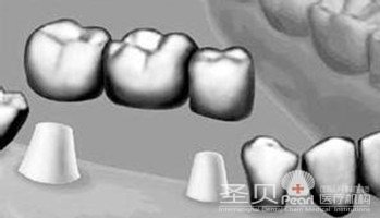 多颗牙齿缺失久拖不治的危害