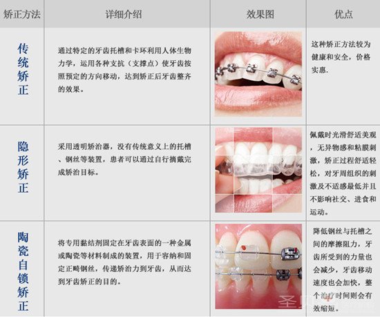 不戴牙套更美的牙齿矫正方法