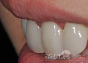 牙科揭秘：镶牙材料哪种好4