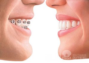 详解：牙齿矫正的相关注意意事项3