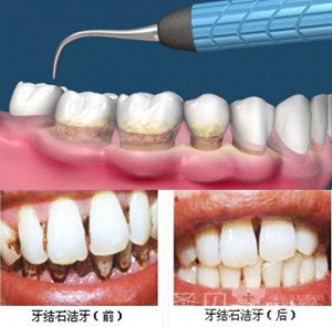 >>>什么样的牙齿适合洁牙?进入挂号中心   