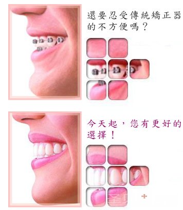 什么是舌侧隐形正畸