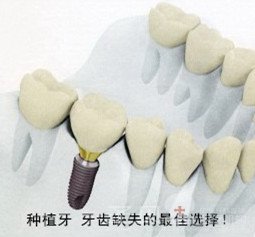 仿生即刻种植牙优点
