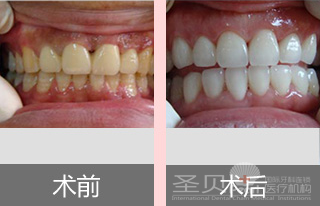 牙齿发黄哪种美白方法好