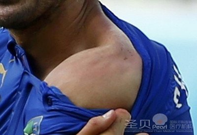 心理学家：苏牙咬人或因龅牙缺陷 幼时遭人嘲笑
