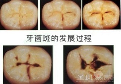 什么是牙菌斑