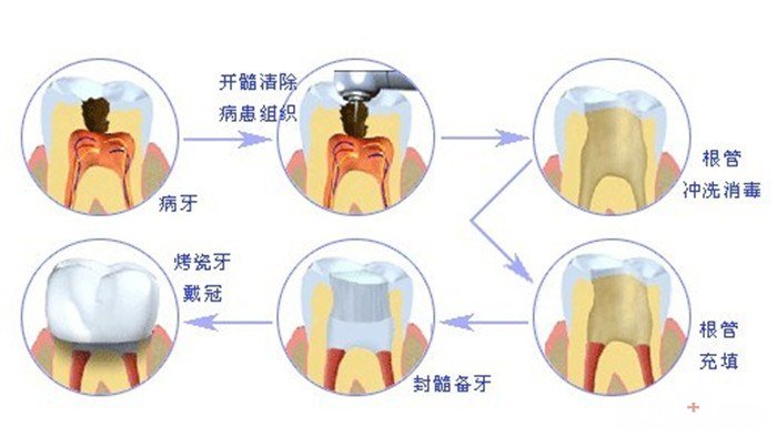 成都牙髓炎疼痛怎么办