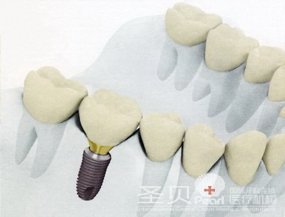 成都治疗牙齿缺失多少钱