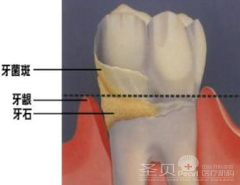 牙结石怎样去除