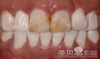 长期抽烟引起烟渍牙怎么办2