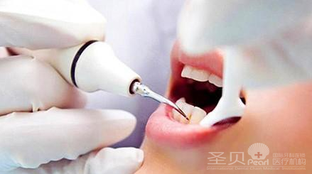 成都洗牙后如何护理牙齿2