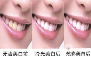牙齿美白全攻略——技术篇2