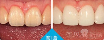 牙齿美白的价格贵不贵2