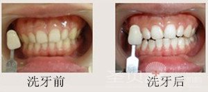 牙齿美白的价格贵不贵4
