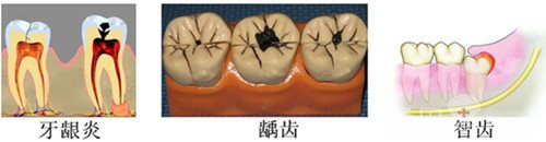 牙痛怎么办  治疗牙痛的有效方法2