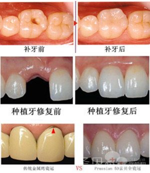 牙齿有洞怎么办4