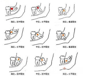 智齿该不该拔除2