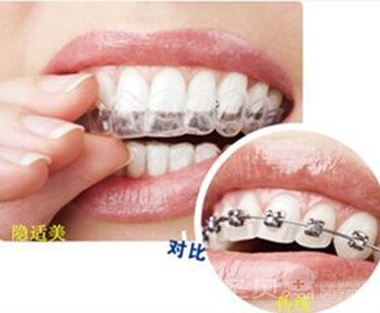戴牙套可以改变脸型吗3