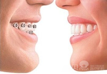 戴牙套可以改变脸型吗2