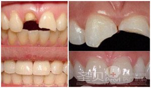 牙齿缺了一块能补吗