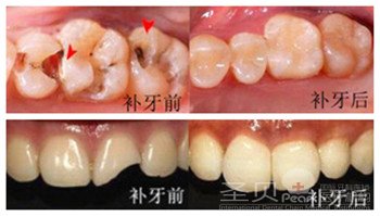 补牙的注意意事项及治疗方式