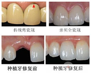 补牙的注意意事项及治疗方式3