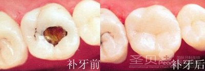 牙齿坏了疼痛怎么办4