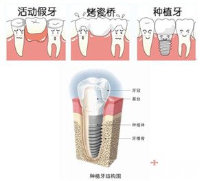 镶牙全攻略——技术篇