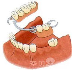 镶牙全攻略——技术篇2