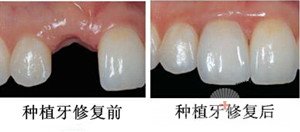 镶牙全攻略——技术篇5