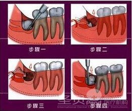 拔牙全攻略——技术篇