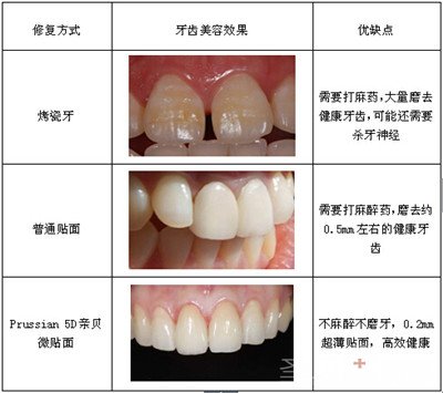 瓷贴面全攻略——技术篇3