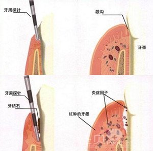 牙龈出血是什么原因 怎么治疗2
