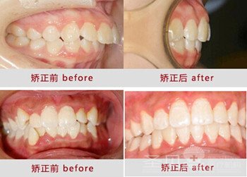 正畸告诉你 牙齿矫正哪种方法好4