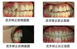 详解：牙齿矫正的相关注意意事项2