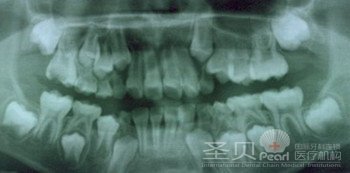 详解：牙齿矫正的相关注意意事项