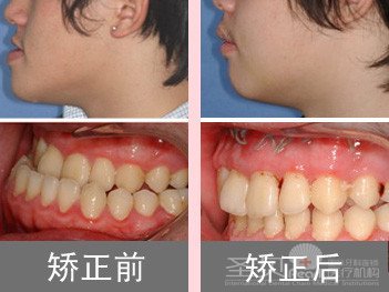 详解：牙齿矫正的相关注意意事项4