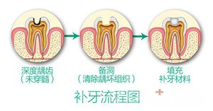 补牙全攻略——技术篇