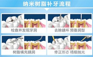 补牙全攻略——技术篇4