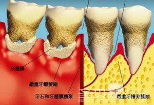 牙龈萎缩怎么办2