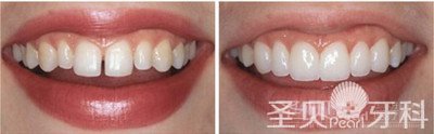 牙缝大怎么办 方法决定效果2