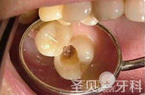 牙齿有洞怎么办
