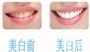牙齿美白全攻略——技术篇