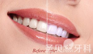 牙齿美白全攻略——技术篇4