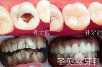 蛀牙全攻略——技术篇