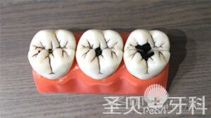 牙齿有了蛀牙怎么办