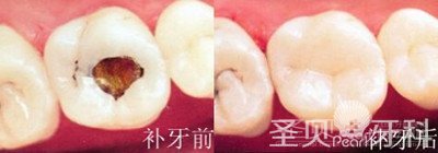 牙齿有了蛀牙怎么办3