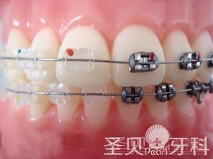 正畸告诉你 牙齿矫正哪种方法好3