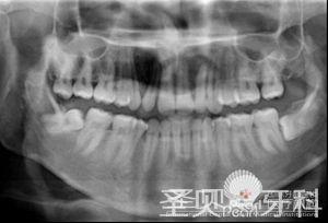 拔牙的价格贵不贵2